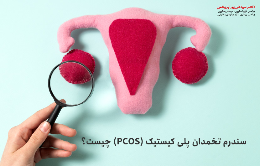 سندرم تخمدان پلی کیستیک