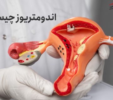 اندومتریوز