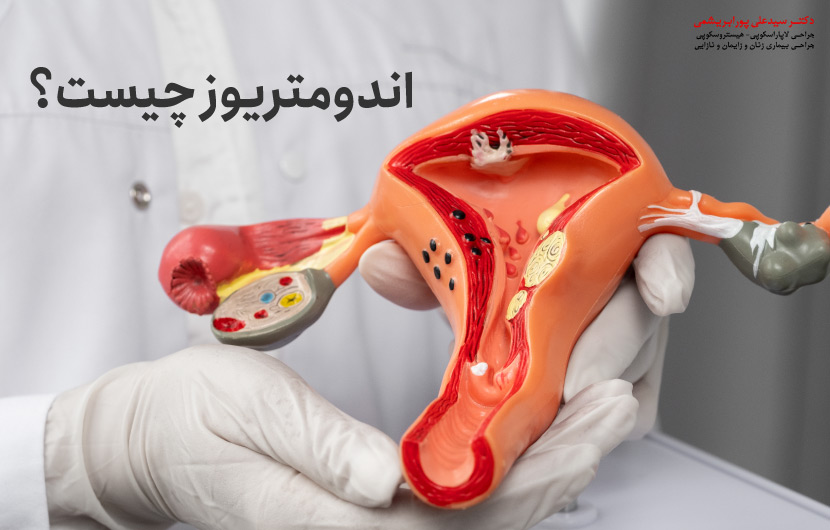 اندومتریوز